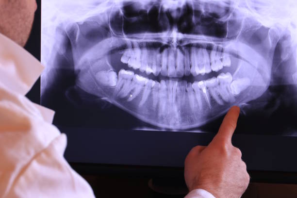 Best Knocked-Out Tooth (Avulsed Tooth) Treatment in Hickman, NE